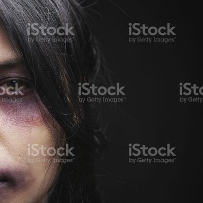 멍 상처 흉터 폭력 여성 얼굴